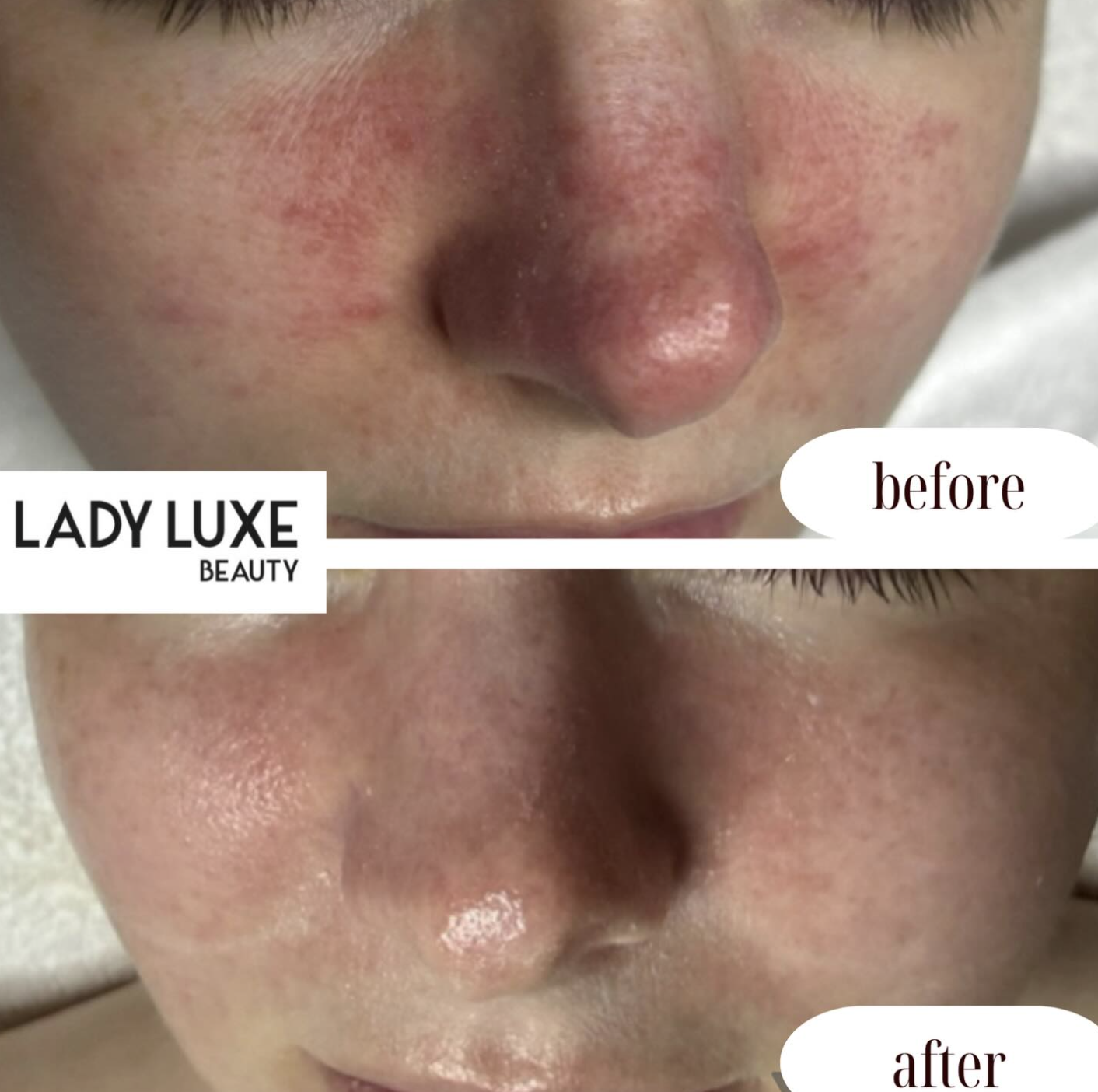Rosacea before and after