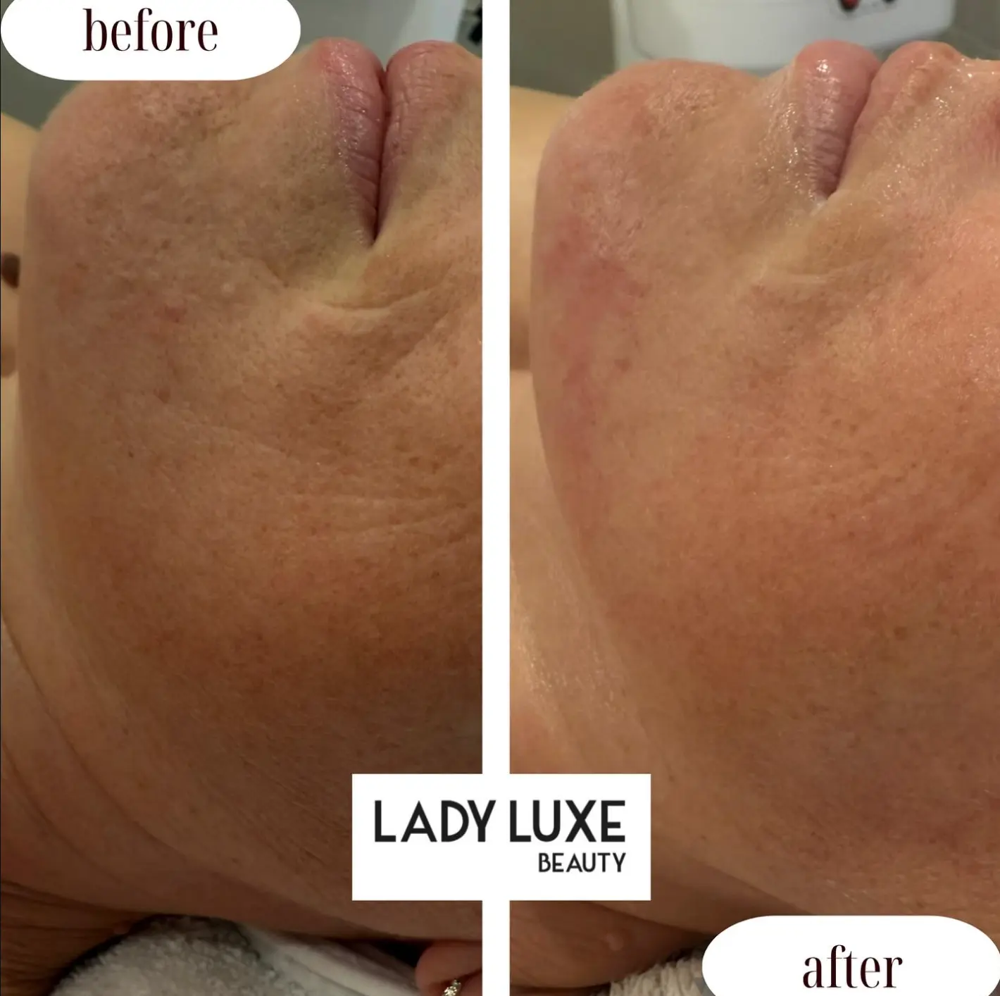 Skin Texture before and after