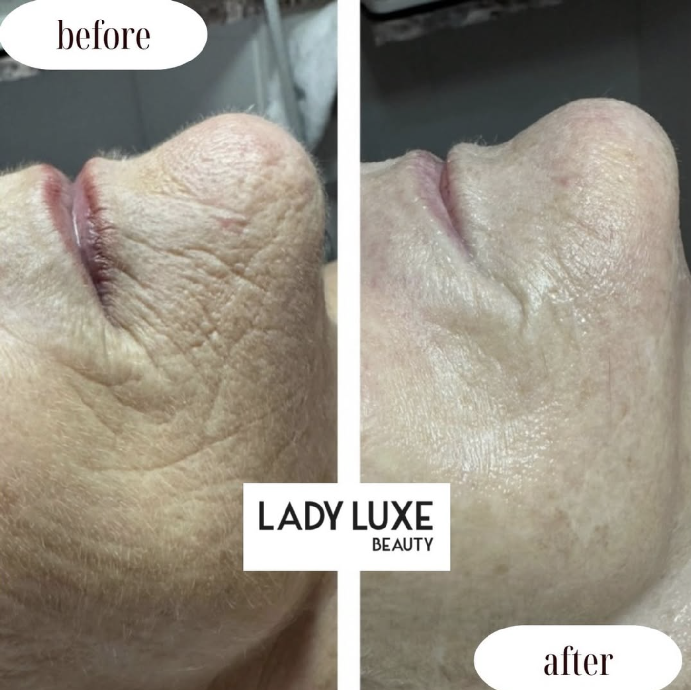 Fine Lines before and after